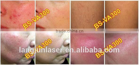 Beautiful Professional Cure Telangiectasia Treatment Vein Removal Equipment