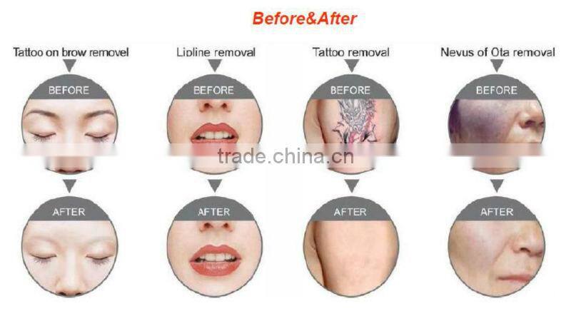 TUV/CE approved nd yag laser dark skin tattoo removal with 1064&532 nm