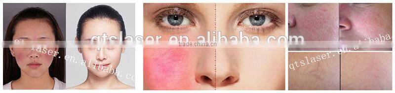 30MHz Raido Frequency RBS For Red Blood Silk Removal