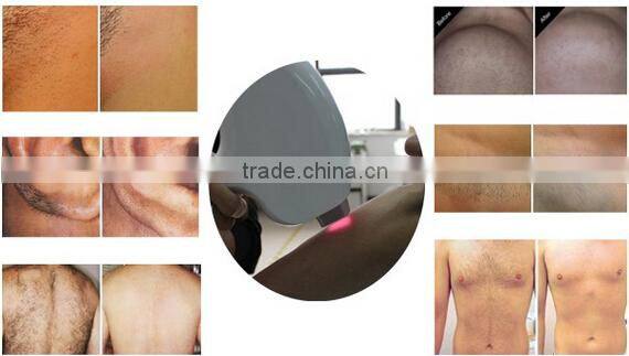 12*20mm laser spot 20 million flashes DILAS 808/810 Painless Permanent Fast 808 diode laser