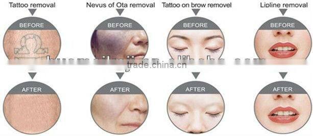 Portable Q-Switched ND YAG Laser Tattoo Removal machine