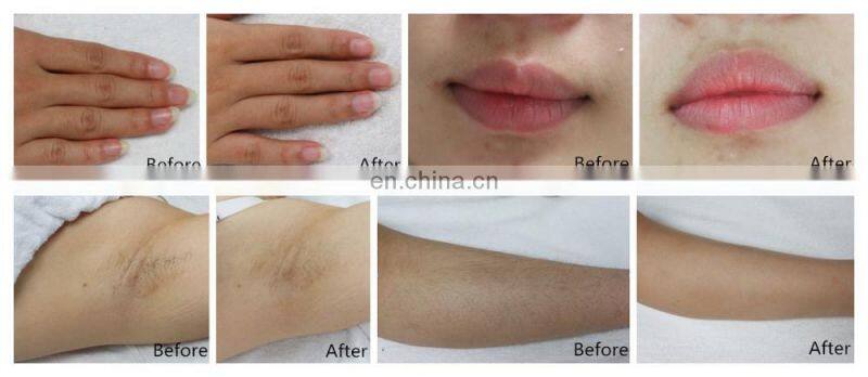 DEESS Xmas gift automatic flashing can support  family permanent hair removal photo facial machine