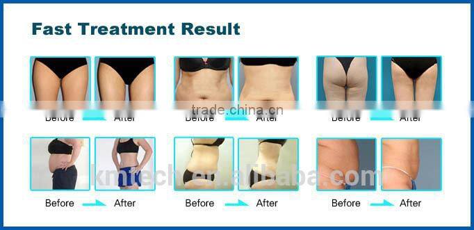 2016 elight ipl rf nd yag laser tattoo removal/skin rejuvenation machine