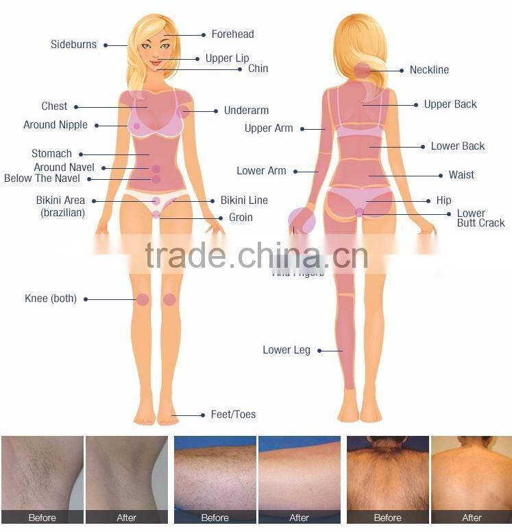 2017 Hot sale 808 hair laser removal 808nm diode laser hair removal machine/laser diode 808nm /laser diodo 808nm