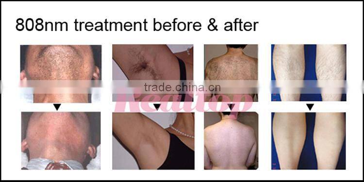 NEW HOT!!! 2016 Worldwide Distributors Wanted Promotional Quick Lead Cheap Diode Laser Hair Removal 808nm SHR IPL Hair Removal