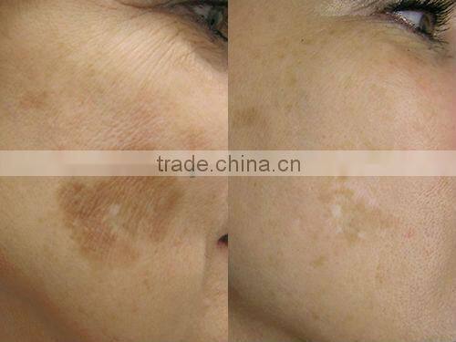 women lady nono lase hair removal machine epilator shaver for face and body home