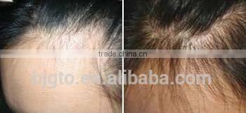 GTO 2014New GMT 540needles micro needle derma roller with blue violet head