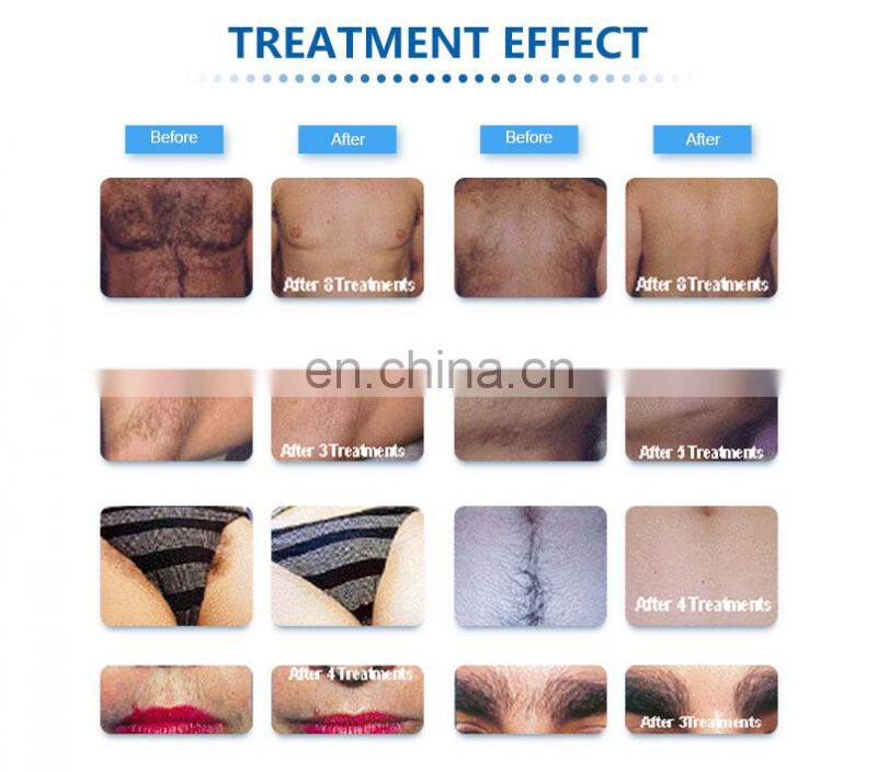 Trending products new arrivals soprano ice 755nm 808nm 1064nm diode laser permanent facial hair removal