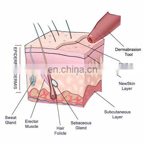 portable vacuum suction blackhead removal dermic diamond tip peel microdermabrasion machine for sale