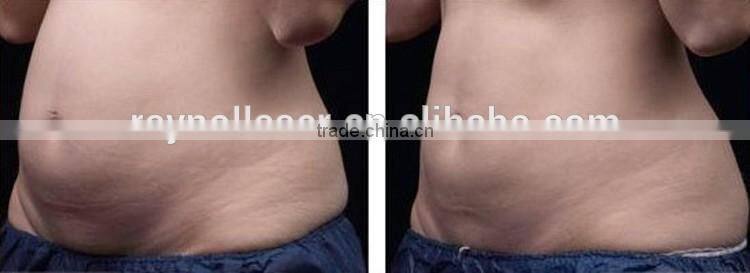 Ultrasonic Liposuction Body Shape Slimming Equipment