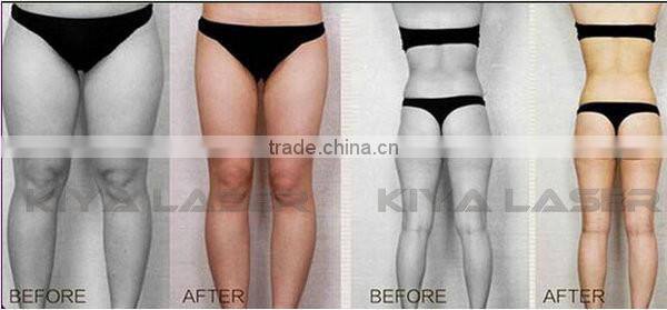 Distributor price support! high quality liposonix hifu body sliming machine