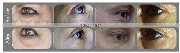 OEM&ODM popular accent ultra beautiful slimming machine