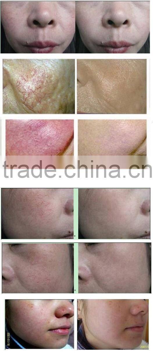 2015 High Quality spider vein removal beauty machine international distributors wanted