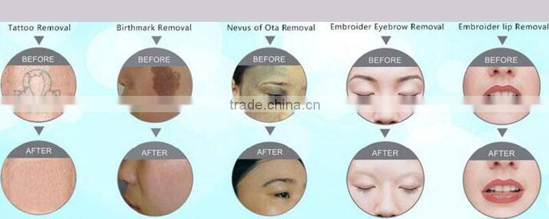 hot sale Beauty salon and spa use tattoo removal /pigmenation removal/nd yag laser price