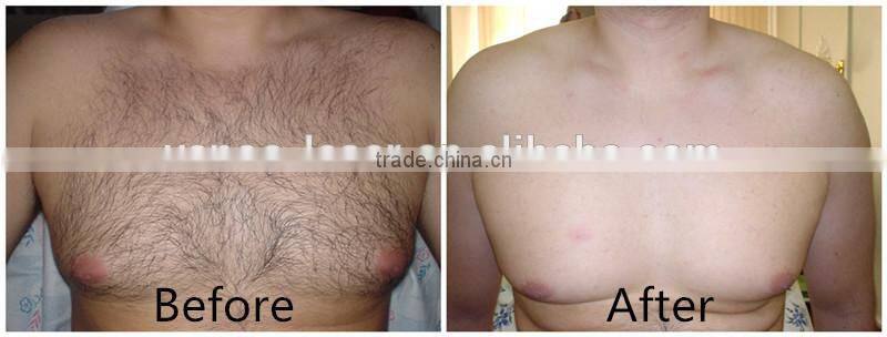 808nm diode laser hair removal beauty equipment with CE certificate