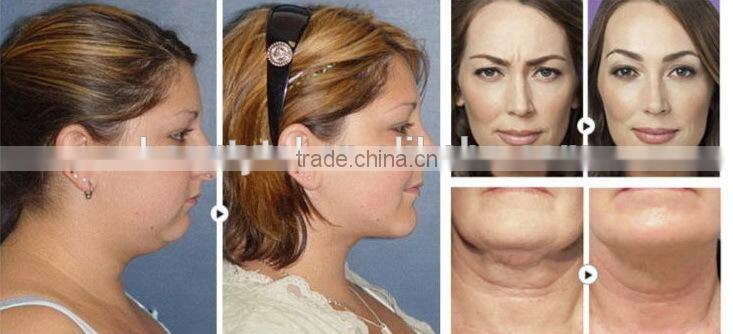 Portable high effective professional fractional rf needling system