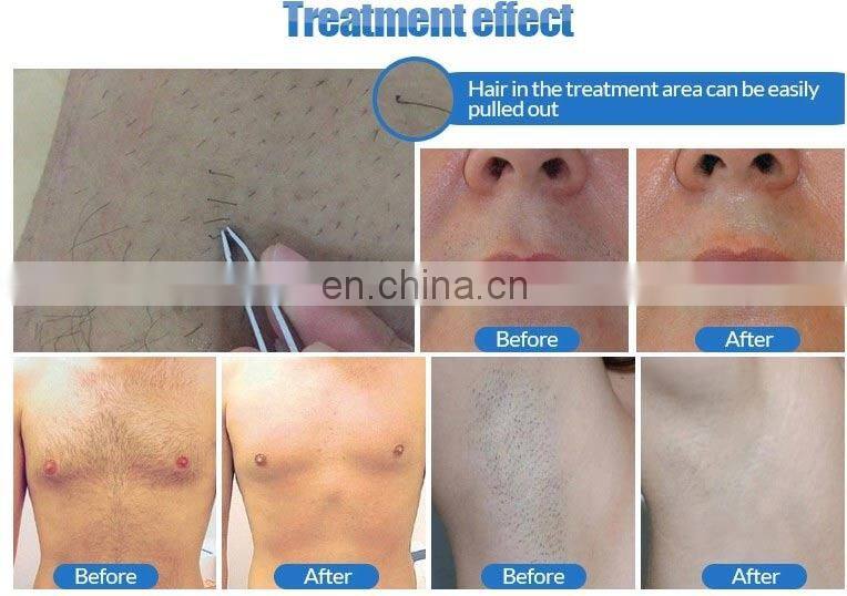 New pain free diode laser 808 810 hair removal laser hair removal machines from israel