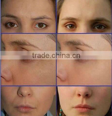 2014 Best Vacuum Weight Loss Cryo Skin Cooling System