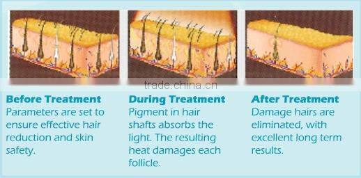 Hottest sale product !!!! professional ipl hair removal machine ipl trolley