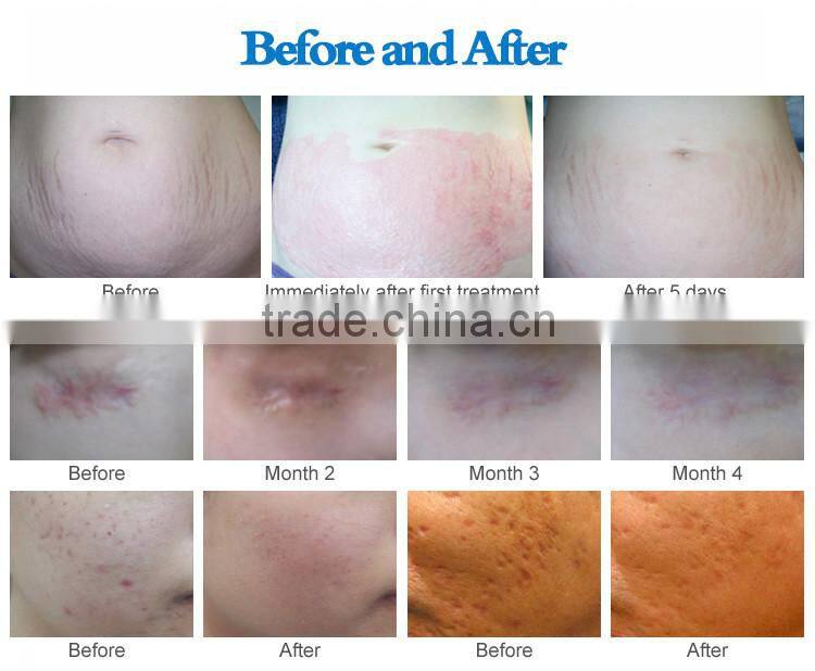 4 in 1 portable electric dr.pen derma pen micro needle for sale