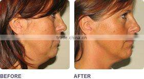 tripolar radio frequency