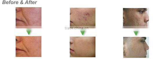 Professional ODM /OEM service 10600nm skin resurfacing & vaginal tightening medical fractional co2 equipment