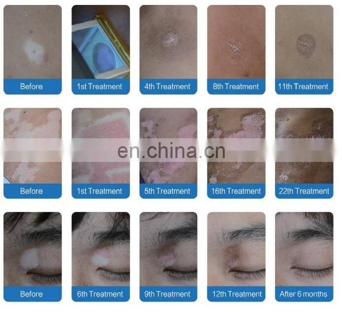 Portable Mini UVB Lamps Psoriasis Vitiligo Treatment Machine 308 Excimer Laser For Skin Disease