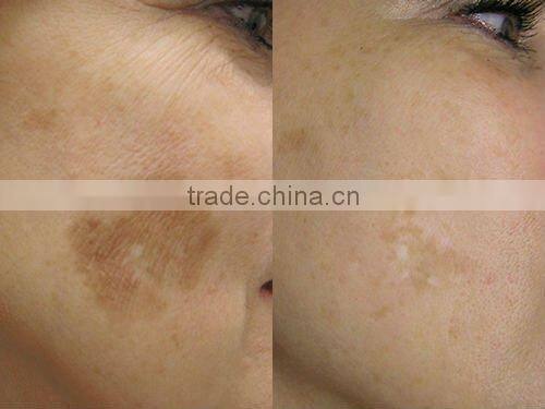 ND yag 1064 laser for pigment freckle and spots removal machine D006