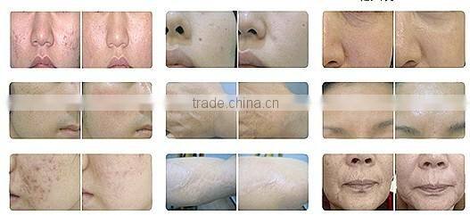 Multi-function fda approved RF co2 Fractional Laser for Skin Rejuvenation