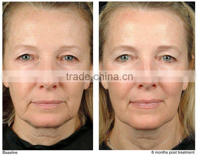 2016 Distributor wanted acne scar removal body permanent hair removal ipl elight shr hair removal machine