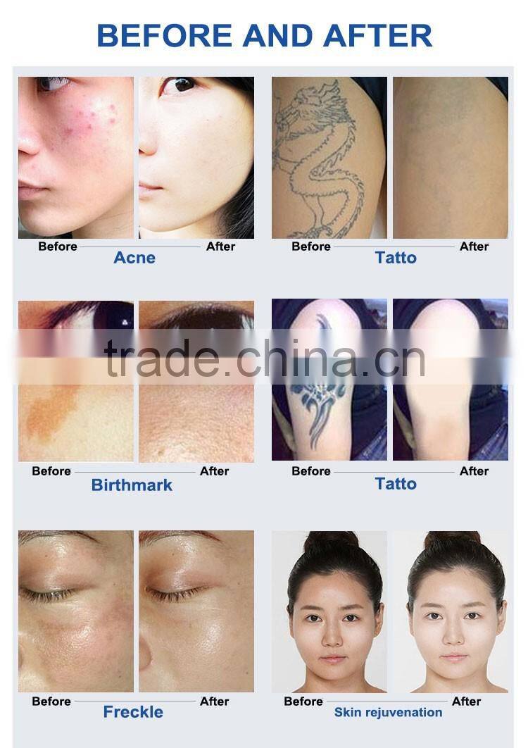 Hot sale Q switch ND YAG Laser & C8 Tattoo Removal Machine / spot Removal