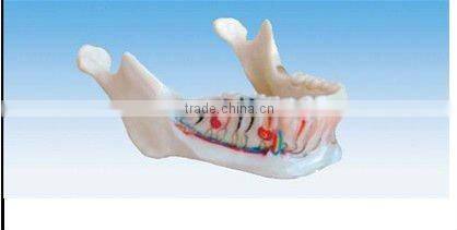 pathology Transparent teeth model