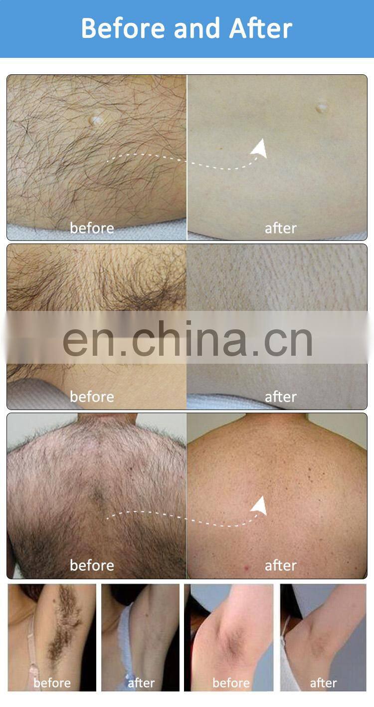 Vertical 808 diode laser therapy picosecond tattoo pigment removal hair removal machine