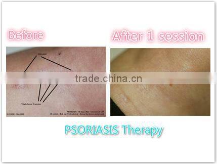 fast beauty device!!!CDT CO2 carboxy equipment/carboxy therapy machine