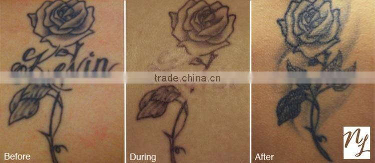 Professional Q-switch ND YAG Laser