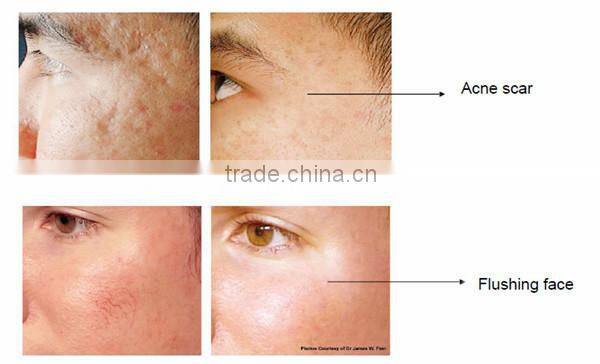 2015 hot selling radiofrecuencia rf portable equipment