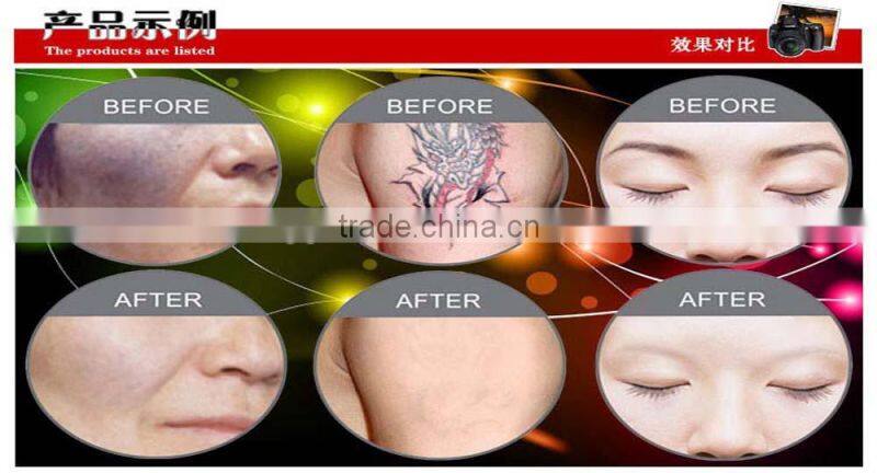 Yag Laser Type Q-Switch tattoo & birth mark removal surgical equipment