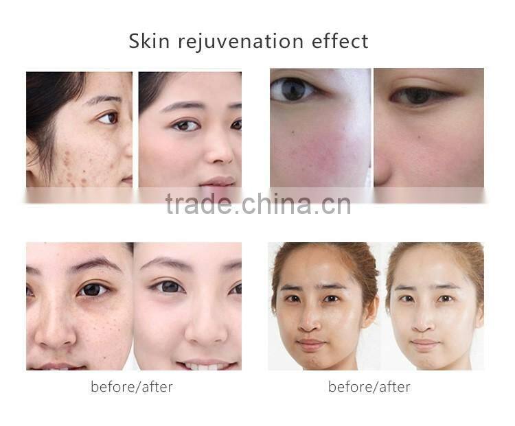 2016 Simply & easy operation Ipl + e-light+ SHR 3 in 1 Mini Hair removal beauty machine in cheap price ipl shr SR HR factory