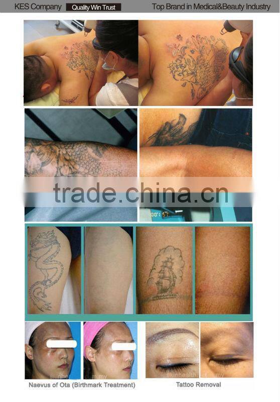 kes laser tattoo removal birthmark q switch nd yag laser electric eyebrow remover