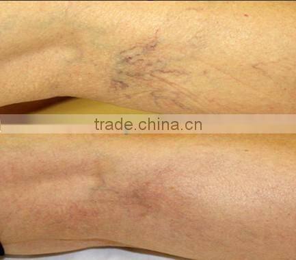 Medical machines--Cooling probe laser Hair removal/varices removal machine-P003 with protect glass/goggle