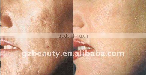 WF-19 Microdermabrasion diamond machine with 9 diamond tips