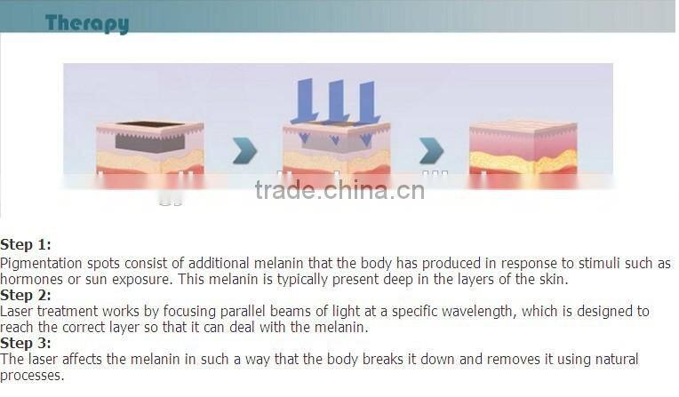 nd yag laser tattoo removal system machine