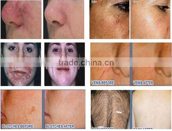 Newest SHR and IPL Promotion !! Only USD2750 Beauty salon/clinic use super hair removal device ipl/shr beauty euipment