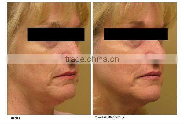 2013 mini body massager ultrasound cavitation slimming machine F013