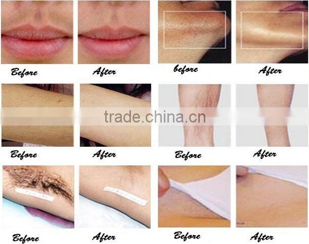 laser machine for tattoo removal / tattoo removal laser for sale / tattoo removal laser