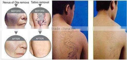 Big discount Newest Medical Q Switch Nd yag Laser Tattoo Removal Equipment