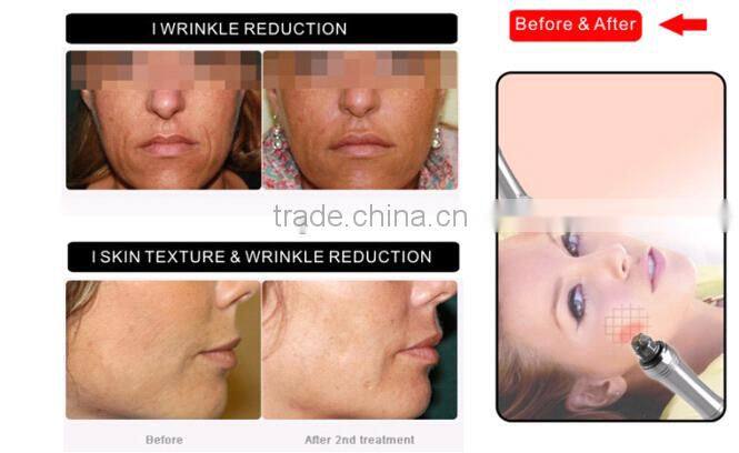 Hot skin tighten fractional rf machine microneedle skin wrinkle, wrinkle removal microneedle RF -MNF100