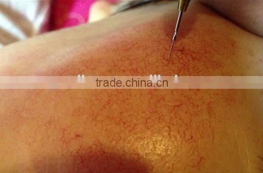 High Frequency 30MHz RBS Painless Spider Veins Removal Beauty Salon Machine