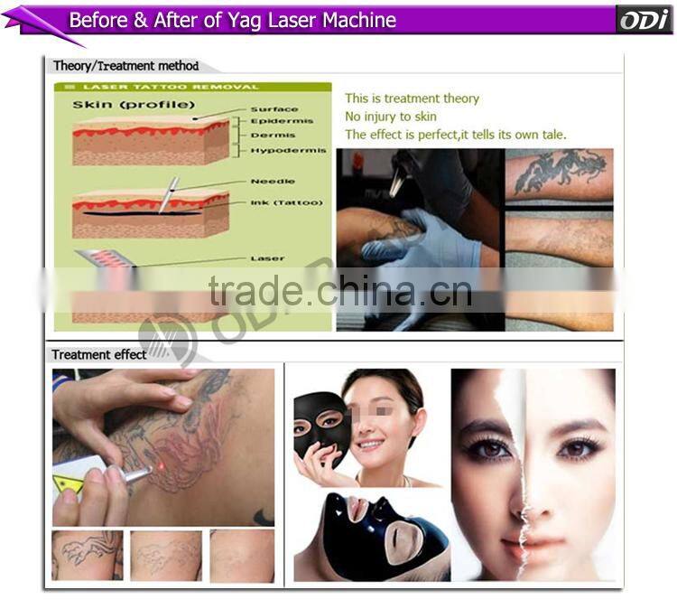 ODI machine manufacturers low laser machine price/beauty skin whitening laser machine