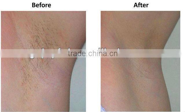 High performance medical equipment beauty laser 808nm diode machine